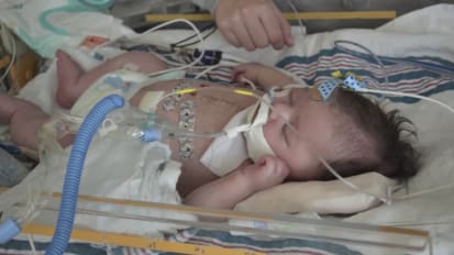 ECMO and a Ross Konno operation saved 6-week old Ruby Munoz