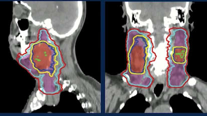 Salivary Gland Transfer for Head & Neck Cancer Patients