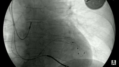 Cardiac Resynchronization Therapy Update
