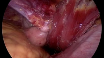 Robotic Abdominoperineal Resection With Robotic Flap Harvest for Vaginal Reconstruction