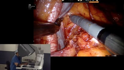 Live Robotic Surgery