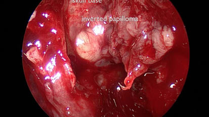 Sinonasal Inverted Papilloma Masquerading As Nasal Polyps