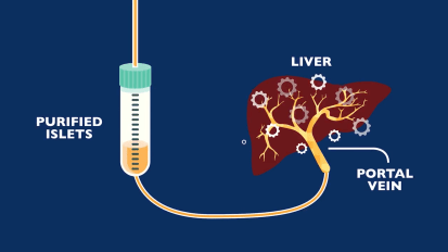 Pancreatic Auto Islet Transplantation with Total Pancreatectomy