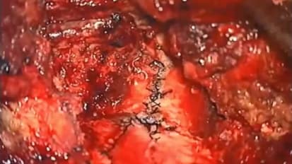 Extreme Lateral Approaches: Evolution, and Applications