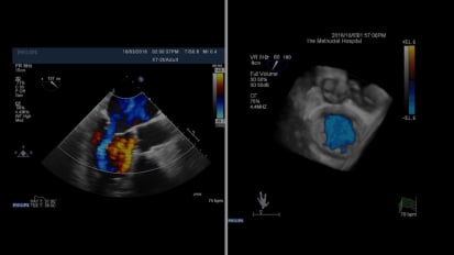 Mitral Valve Clip: 92 Year Old Male (Dyspnea at Rest)