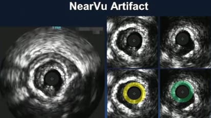 IVUS artifacts