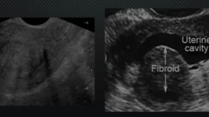 Case Studies: Fibroids