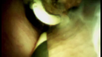 Using the SpyGlass™ Retrieval Snare to Remove a Migrated Stent by Robert D. Fanelli, M.D., Sayre, Pennsylvania, U.S.A. 