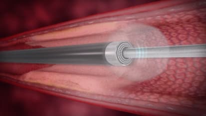 Restenosis Animation