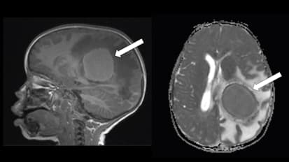 Clinical Case Reports and New mNGS-Based Technologies