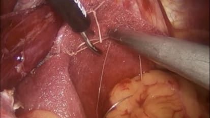 Paraesophageal Hernia Repair Using GORE BIO-A Tissue Reinforcement