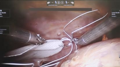 Laparoscopic Fixation of GORE<sup>®</sup> SYNECOR Biomaterial in a Cadaver Model Using a Robotic Arm