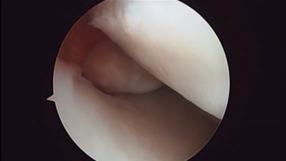 Medial Meniscus Root Tear with Bone Fragment: Repair Technique