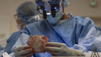 Precision Cranial Reconstruction Using Custom 3D-Printed Skull Prosthesis