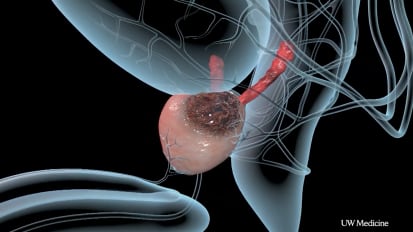 Progress in Prostate Cancer Appears to Slow