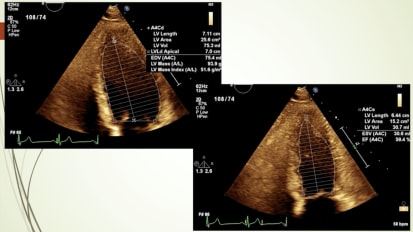 Introduction to Strain Imaging Echocardiography