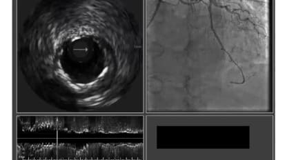 Integrating iFR and IVUS coregistration in the day to day practice