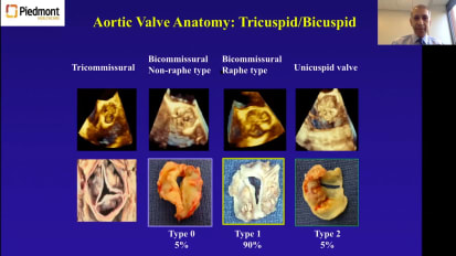 Prosthetic Valves: The Great Debate