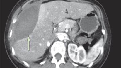 Liver Disease in Pregnancy