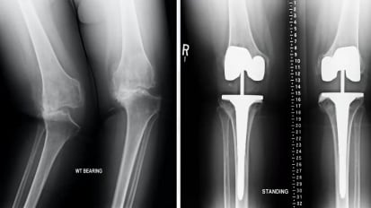 “Kinematic Alignment (KA) for Arthritic Knee Conditions | Dr. Savya Thakkar”