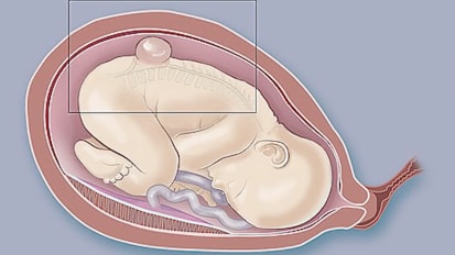 Spina bifida: Surgery plus stem cells before birth could improve outcomes (video)