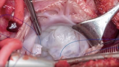 Repair of complete atrioventricular septal defect