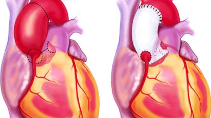 Sentara Grand Rounds - Aortic Graft with Christopher Barreiro, M.D.