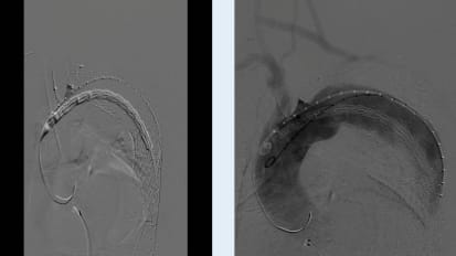 Sentara Grand Rounds - Aortic Graft with Jean Panneton, M.D.