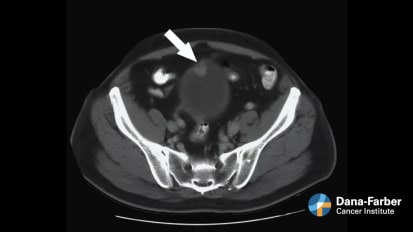 Bladder Cancer Advances