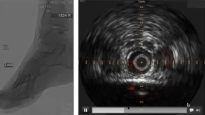 IVUS and Phoenix atherectomy utilization in PAD care 