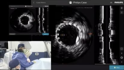 Tibial CTO crossing and revascularization- Live case