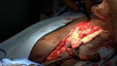 Live Mesh and Hernia Surgical Repair
