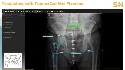 TraumaCad® Digital Templating Overview