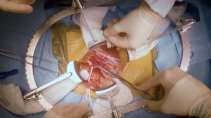 Living Donor Renal Transplant