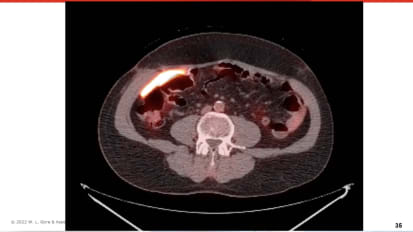 Understanding Absorbable Biomaterials for Hernia Repair and Soft Tissue Reconstruction, Including Treatment Algorithms for Complex Patients
