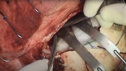 Combined endoscopic and open craniofacial resection for esthesioneuroblastoma