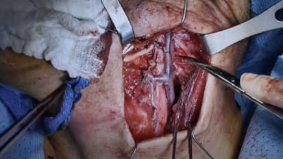 Prophylactic arterial ligation following TORS oropharyngeal cancer resection