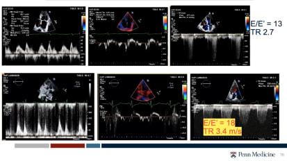 Penn Cardiology Grand Rounds: Finally Relieving the Pressure: New Therapies for HFpEF