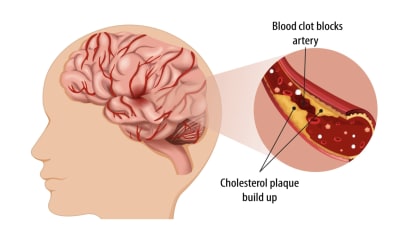Video: Intracranial Atherosclerotic Disease (ICAD)