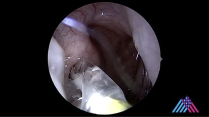 Mount Sinai Otolaryngology Surgical Series: Eustachian Tube Balloon Dilation for Eustachian Tube Dysfunction