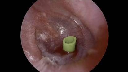 Mount Sinai Otolaryngology Surgical Series: Ear Tube Placement (Myringotomy)