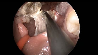 Mount Sinai Otolaryngology Surgical Series: Tonsillectomy