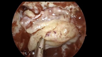 Mount Sinai Otolaryngology Surgical Series: Endoscopic Pituitary Surgery: Transsphenoidal Approach