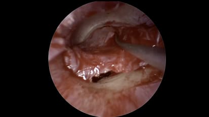 Mount Sinai Otolaryngology Surgical Series: Tympanoplasty: Ear Drum Hole Repair