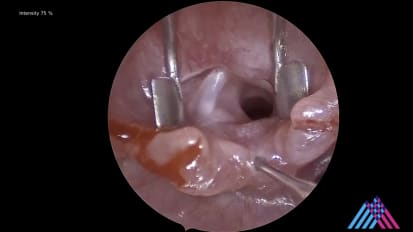Mount Sinai Otolaryngology Surgical Series: Supraglottoplasty and Bronchoscopy for Noisy Breathing