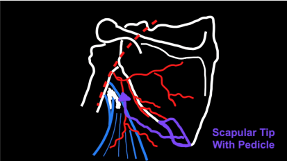 Mount Sinai Otolaryngology Surgical Series: Scapular Tip Free Flap Harvest