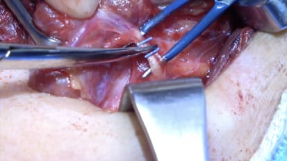 Mount Sinai Otolaryngology Surgical Series: Thyroidectomy