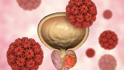 多学科前列腺癌方法