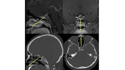 Minimally Invasive Technique Eradicates Recurring Pituitary Abscess