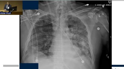 COVID ECMO The Penn Lung Rescue Experience